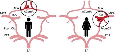 Why Are Women Predisposed to Intracranial Aneurysm?